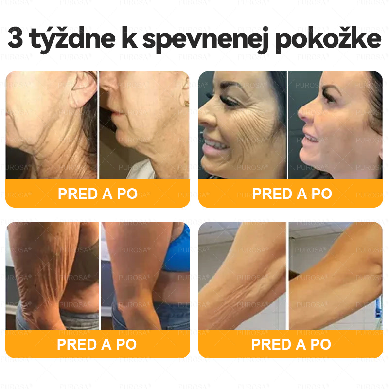 Izdelano in odposlano iz Slovenije 🏆 PUROSA® Krema z čebeljim strupom za obnovo kože  ⏰ ZADNJI DAN – 80 % POPUST!