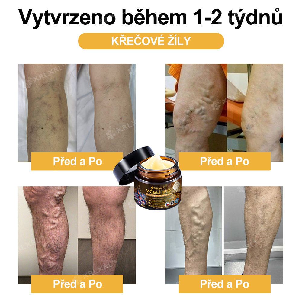 Oficiální obchod: 🦵 XRLXRL® okamžitý ultra silný krém s včelím jedem proti bolesti – (Zklidňuje bolest při artritidě, bolesti svalů, zad, kolen, ramen, kyčlí, zápěstí a rukou)